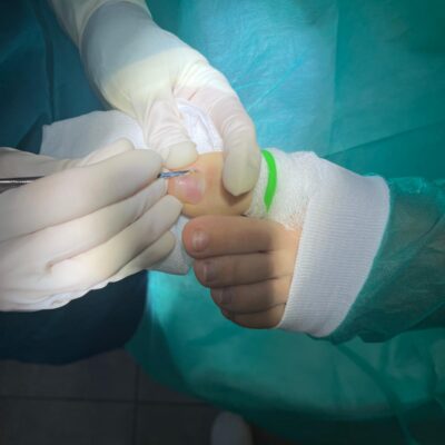 clínica podológica Dra. Ana Oltra - cirugía de la una (1)